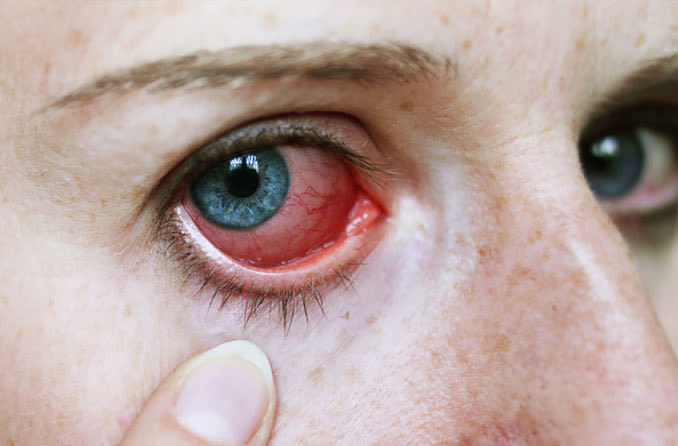hero-article-enuk-conditions-uveitis.jpg