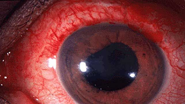 4067-uveitis-642x361-anterior-uveitis-slide1.jpg