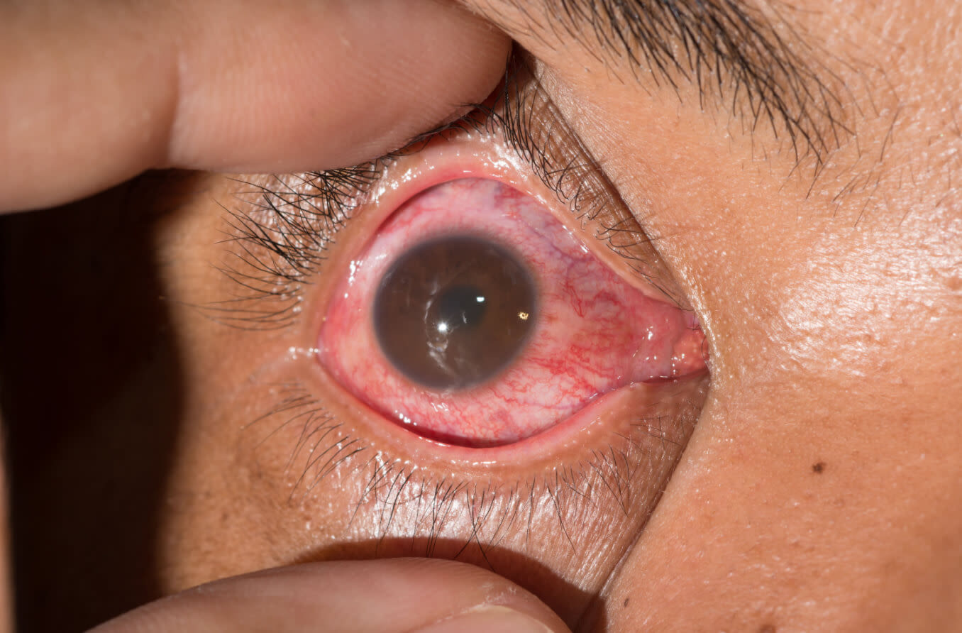 uveitis-eye-condition.jpg